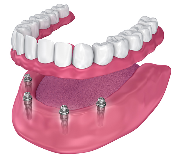 Bloomfield All-on-4 Implants