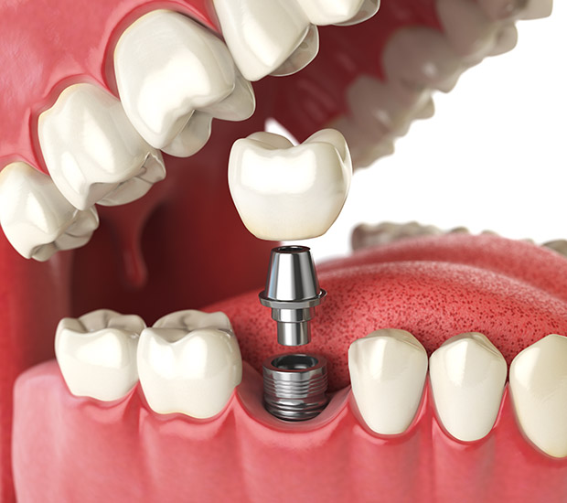 Bloomfield Will I Need a Bone Graft for Dental Implants