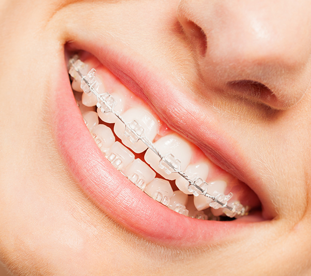 Bloomfield Clear Braces