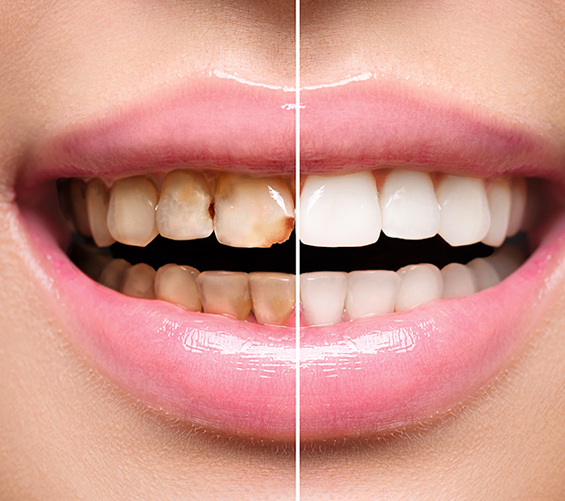 Bloomfield Dental Implant Restoration