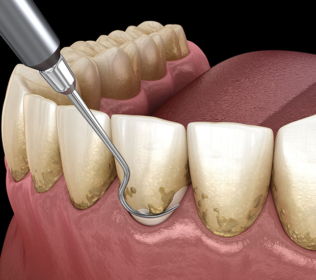 Bloomfield Root Scaling and Planing